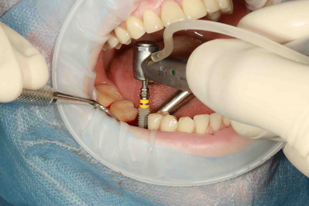 Person getting dental implants surgery