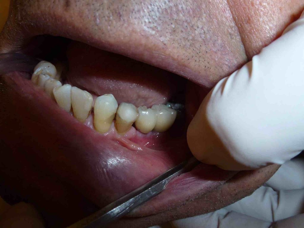 Picture of a man's dental implants