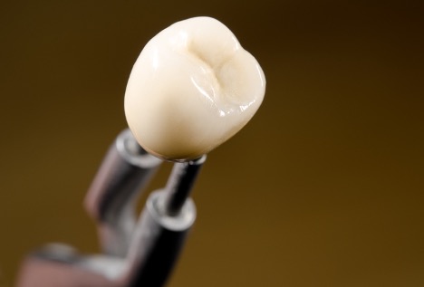 Picture of a tooth veneer